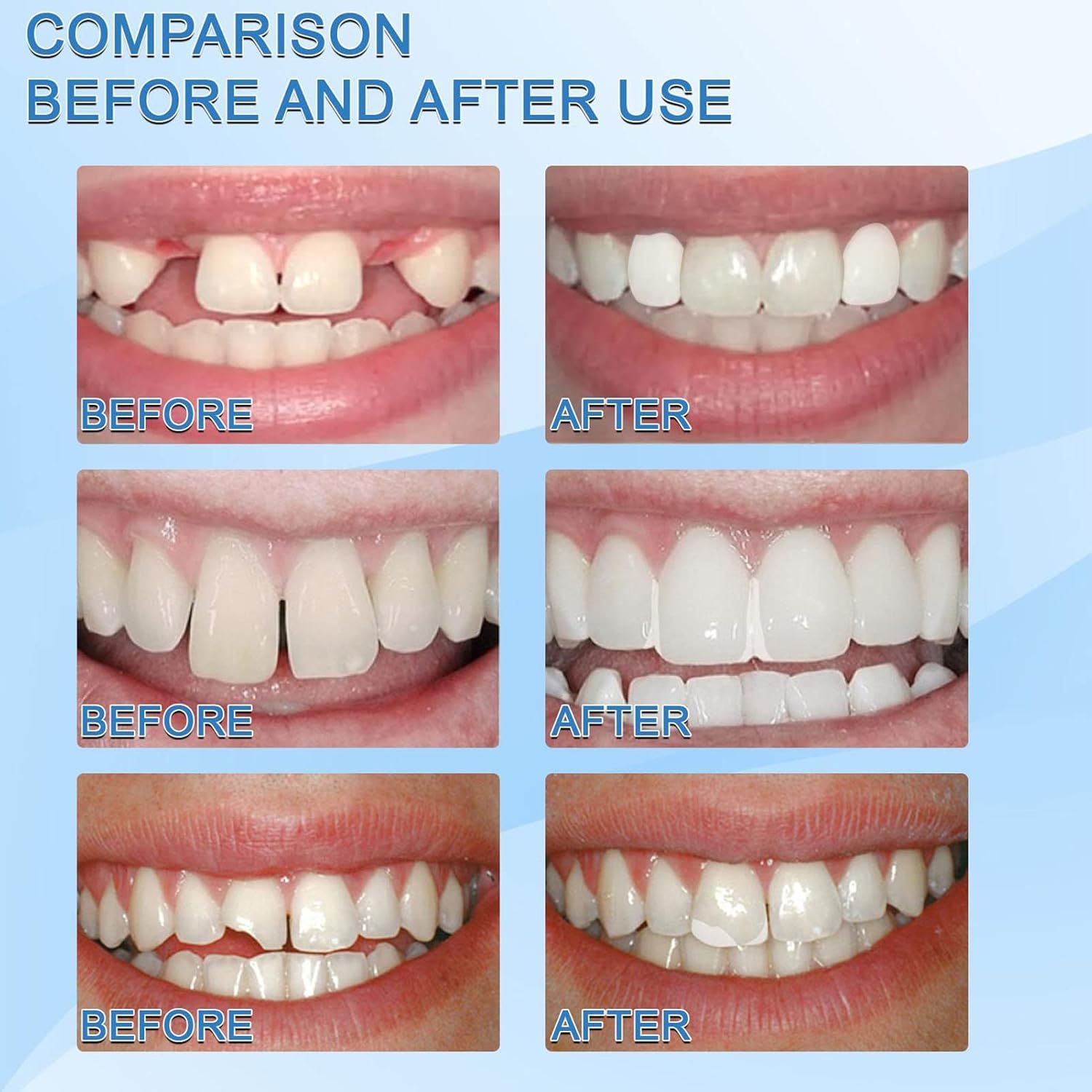 2 x 1 Reparación/ relleno  de dientes  temporal con ENVÍO GRATIS ⭐⭐⭐⭐⭐