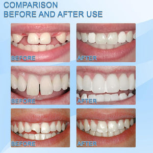 2 x 1 Reparación/ relleno  de dientes  temporal con ENVÍO GRATIS ⭐⭐⭐⭐⭐